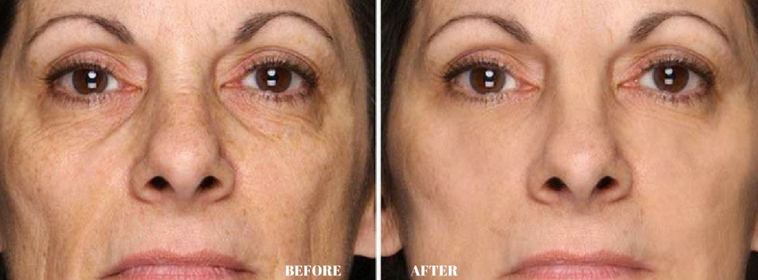 Dermology Anti Aging Cream Before and After