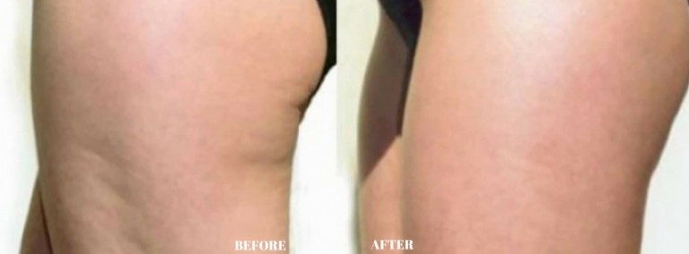 Dermology Cellulite Cream Before and After