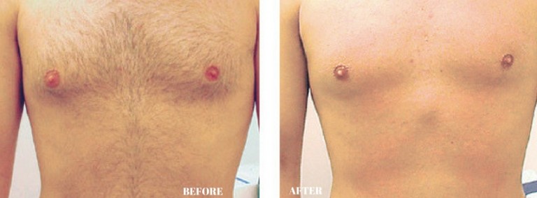 Dermology Hair Removal Cream Before and After