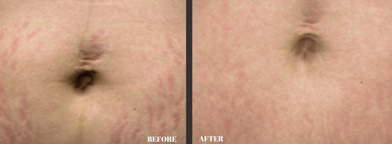 Dermology Stretch Mark Cream Before and After