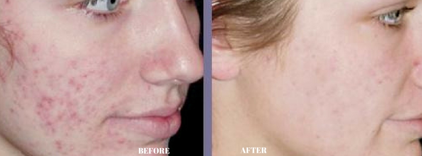 dermology acne treatment cream before and after