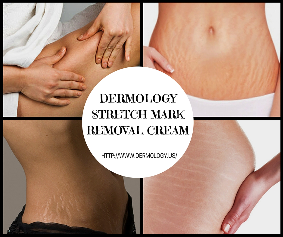 Dermology Stretch Mark Removal Cream