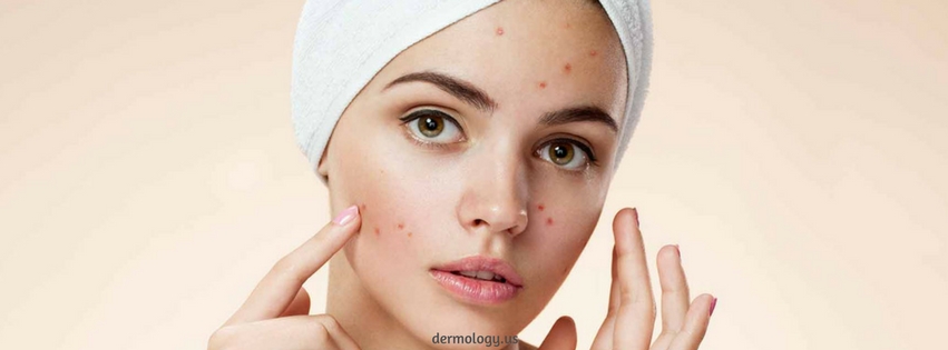 Facts about Acne