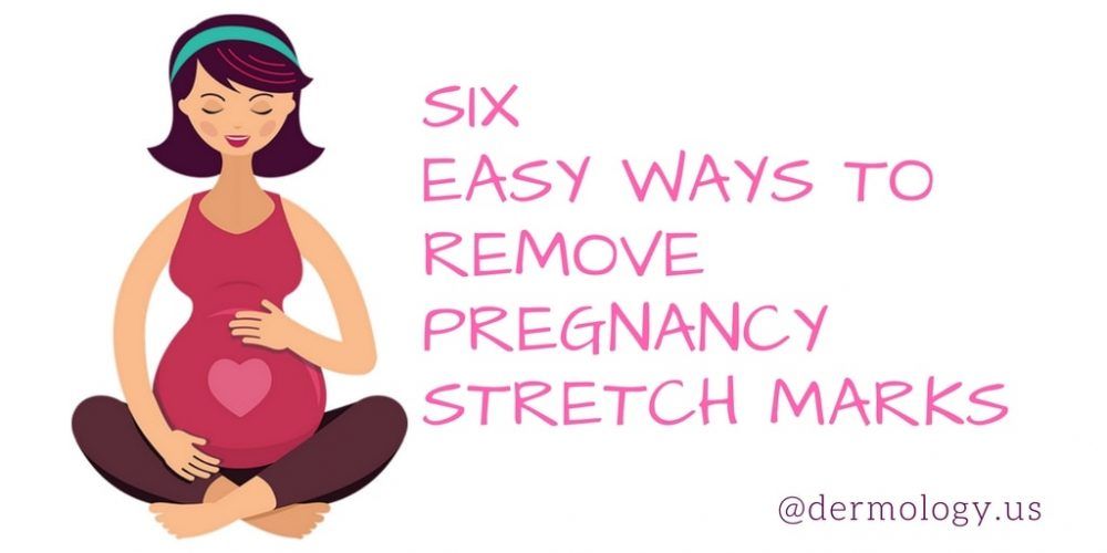 Remove-Pregnancy-stretch-Marks