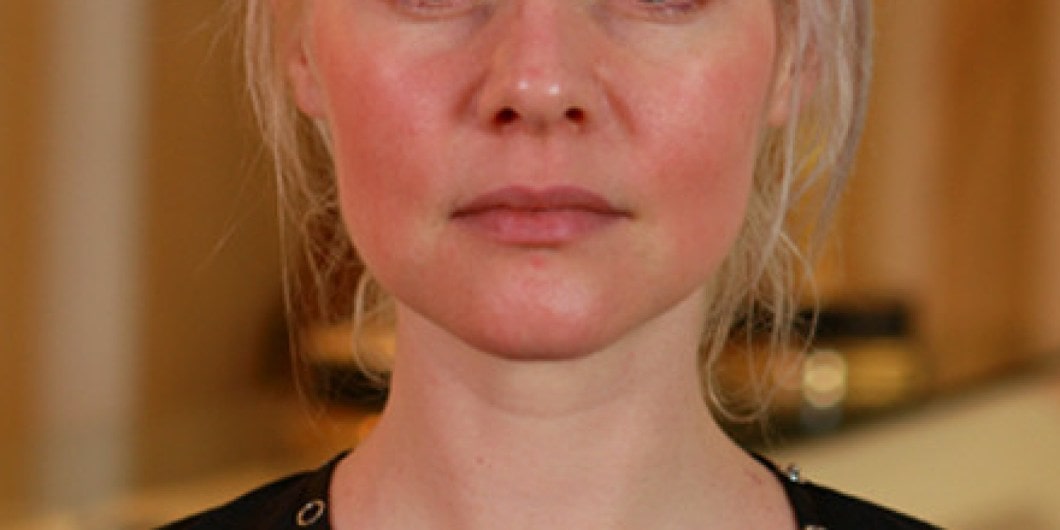 ROSACEA