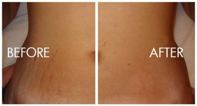 How-to-Avoid-Stretch-Marks-1