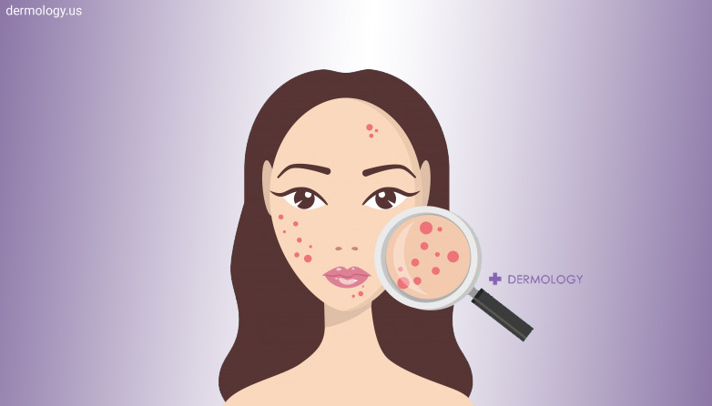 Acne prone skin