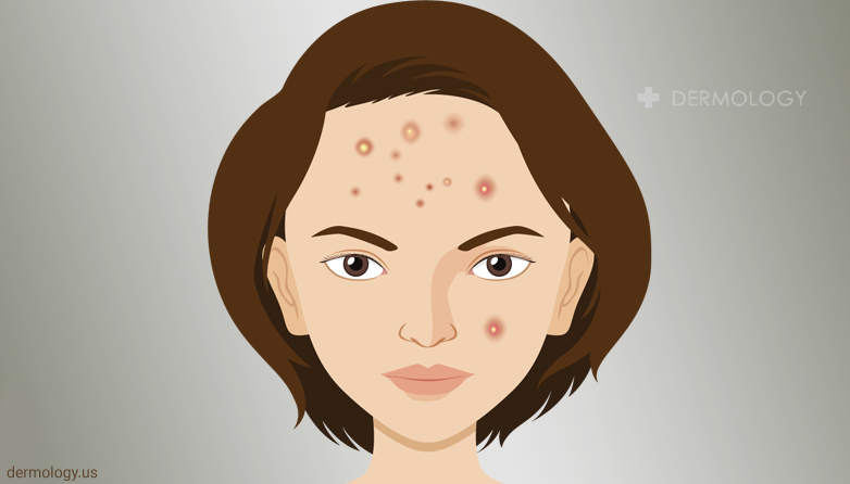 acne on face